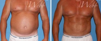 Male Lipo Middle Tennessee