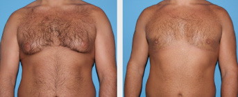Male Breast Reduction Middle Tennessee