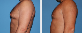 Male Breast Reduction Middle Tennessee