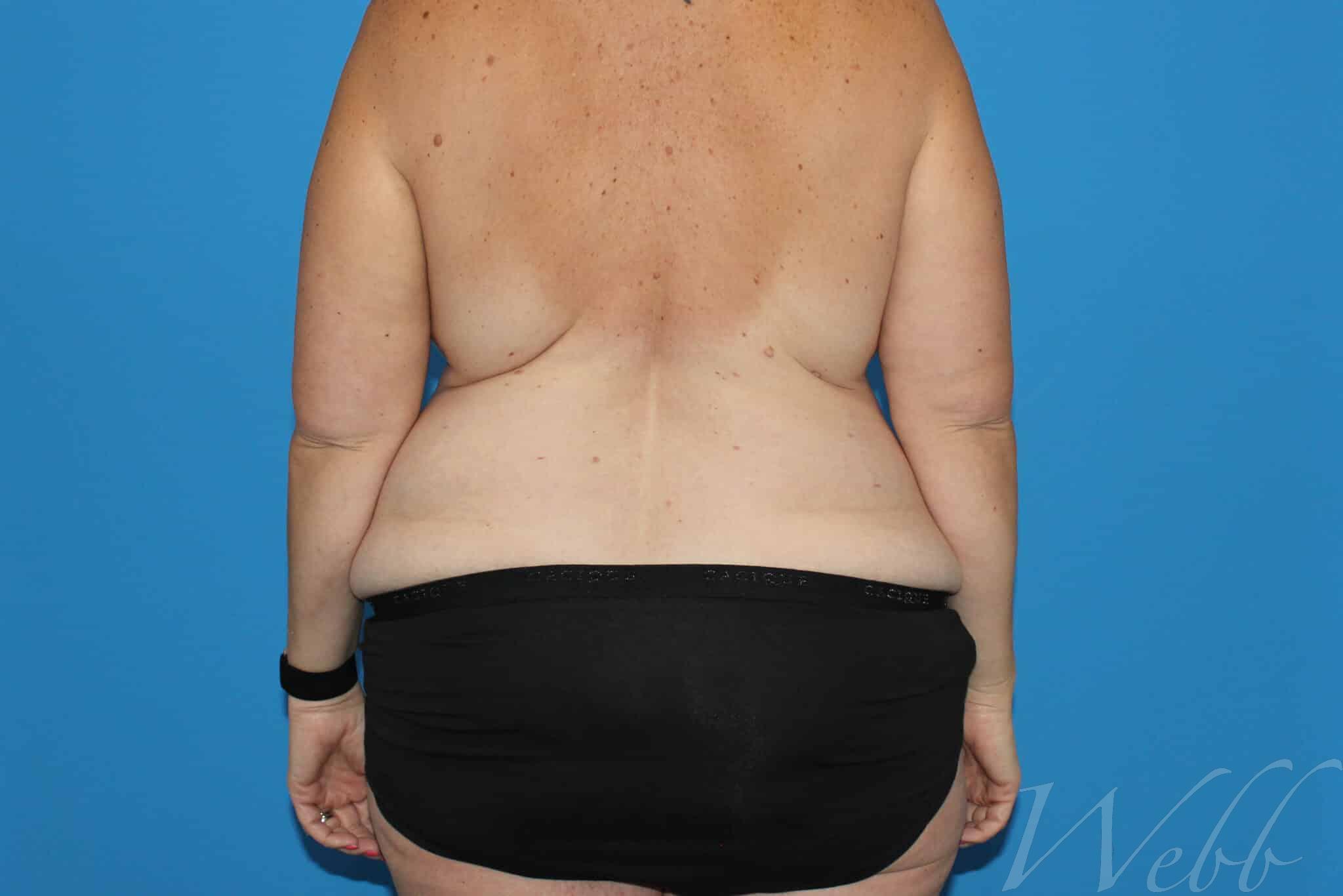 bra line backlift patient