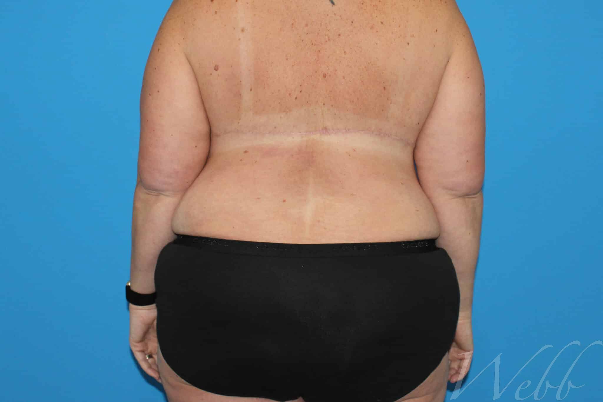 bra line backlift patient