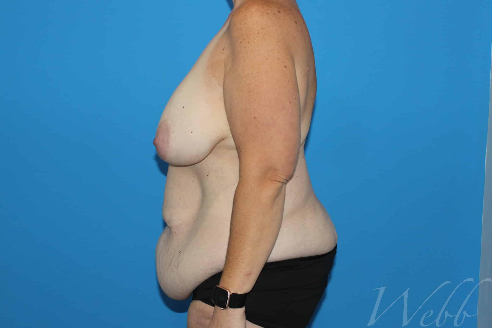 bra line backlift patient