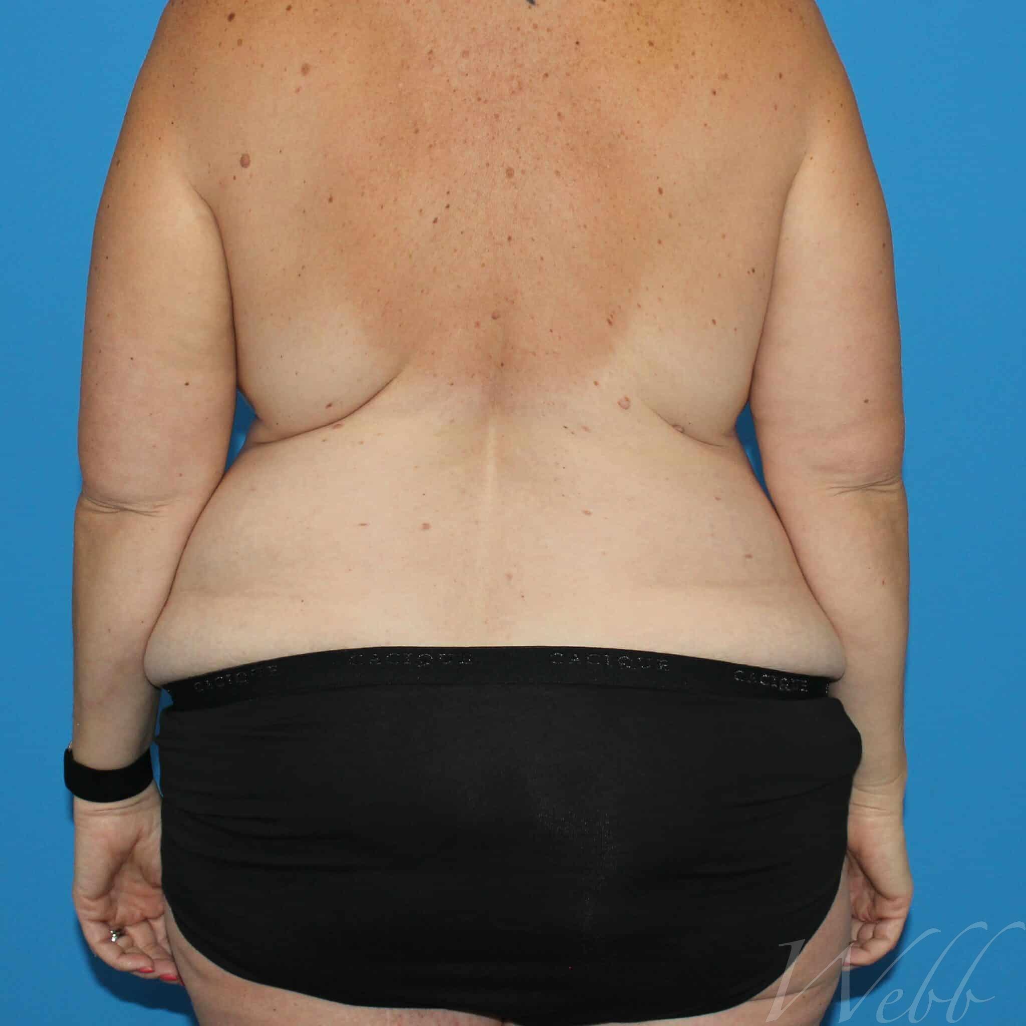 Bra Line Back Lift Before & After Photos Patient 112