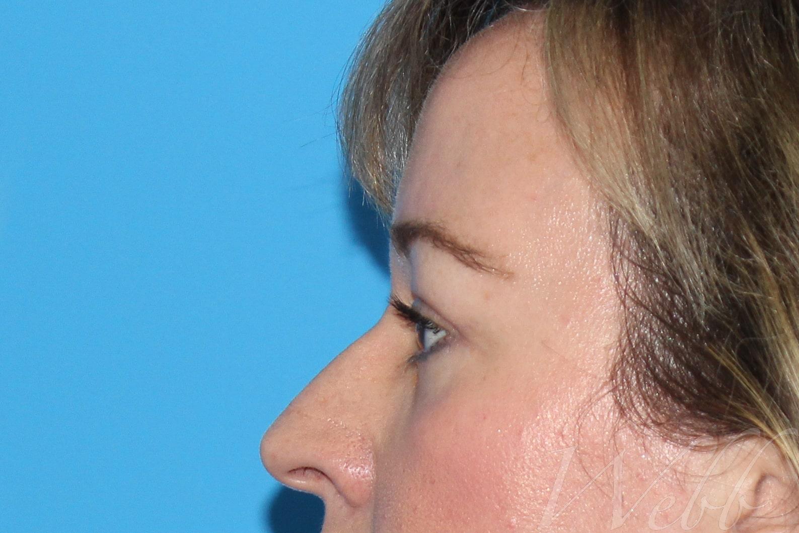 eyelid rejuvenation patient