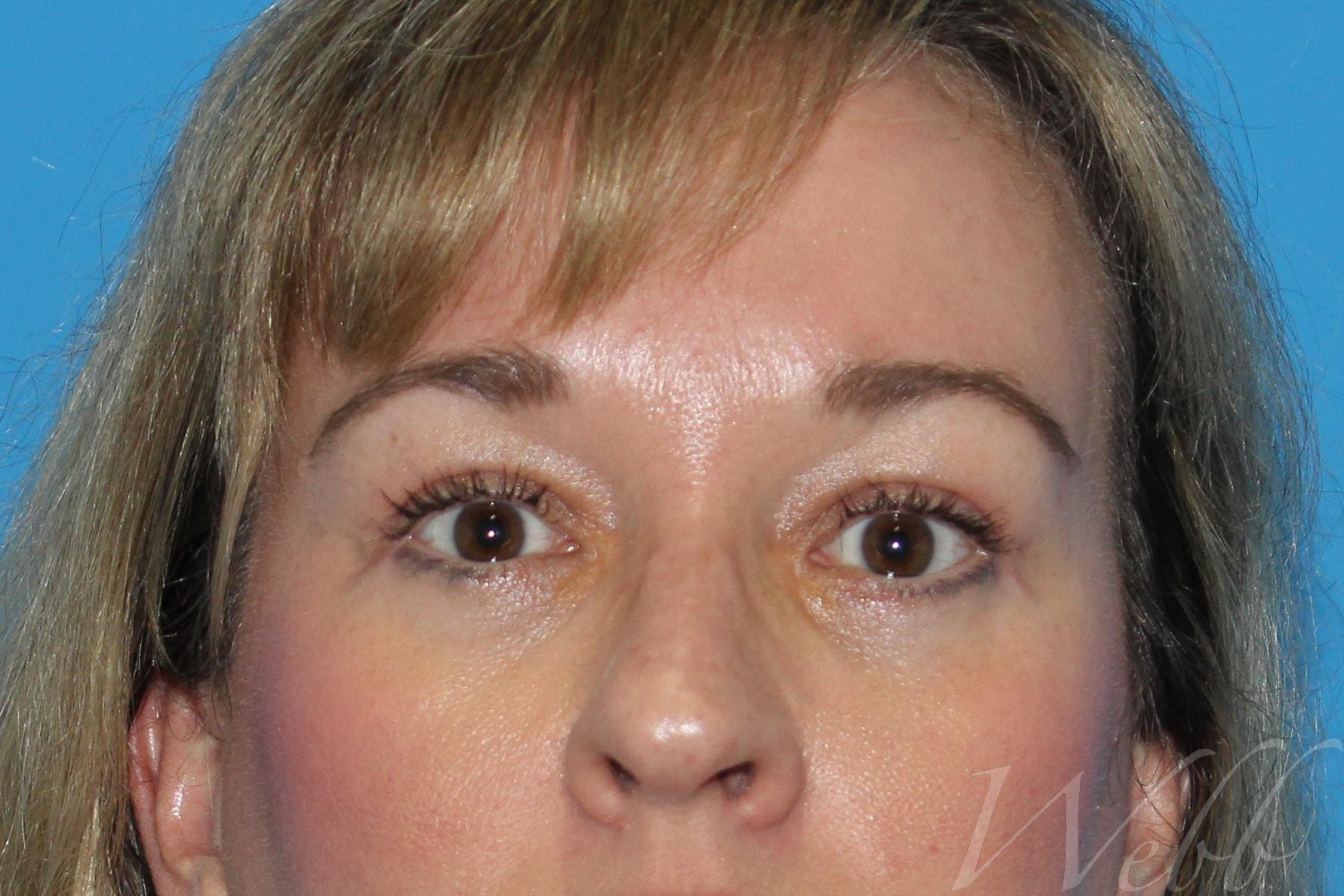 eyelid rejuvenation patient