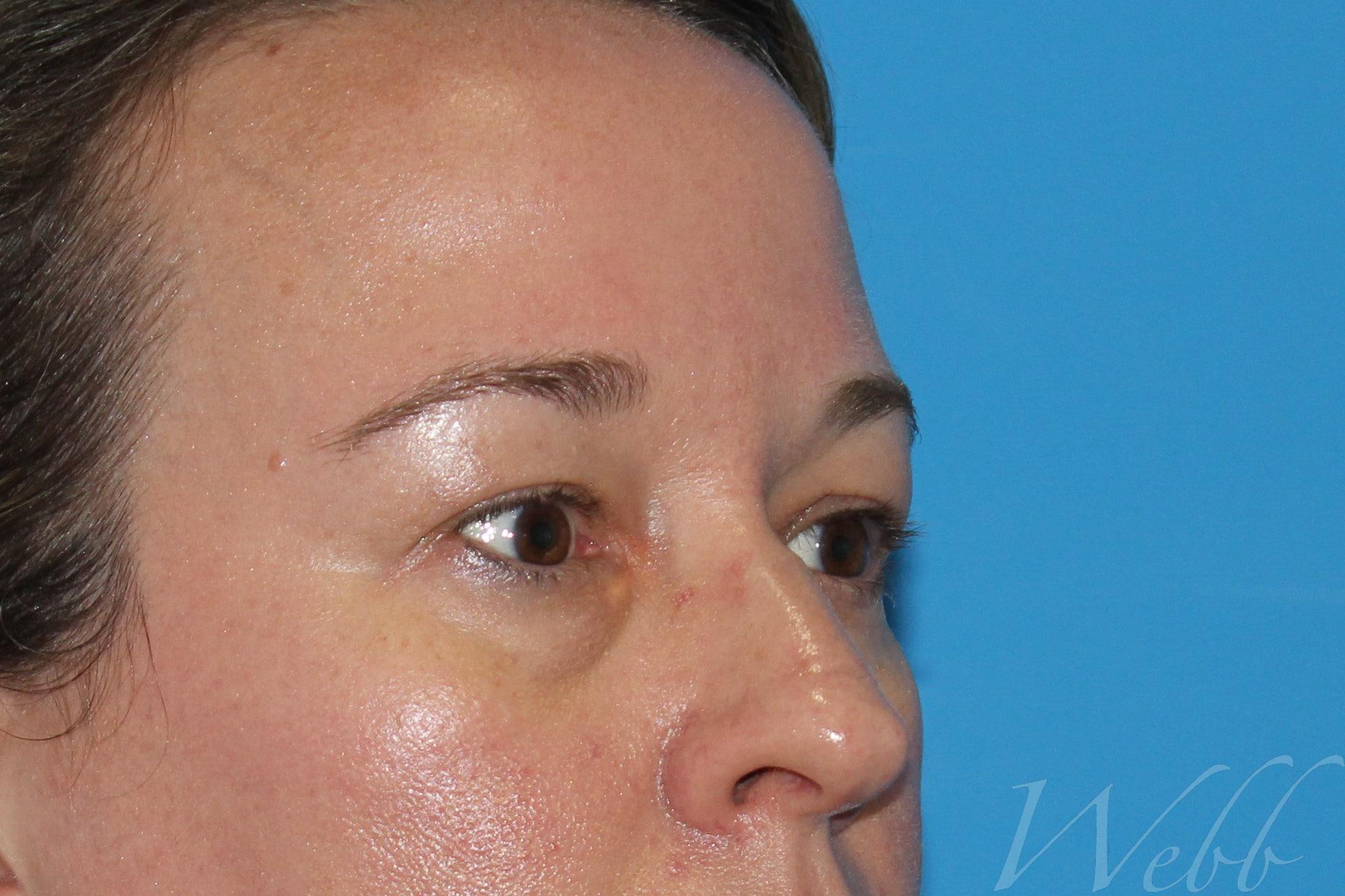 eyelid rejuvenation patient