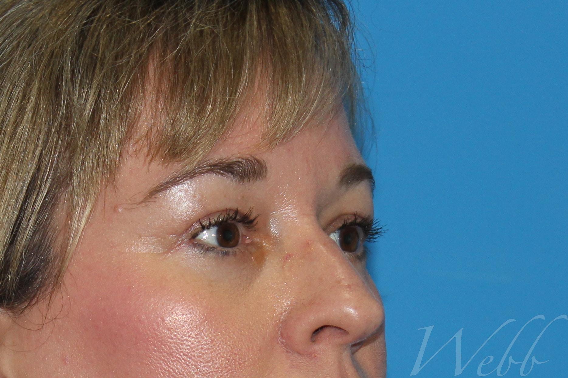 eyelid rejuvenation patient