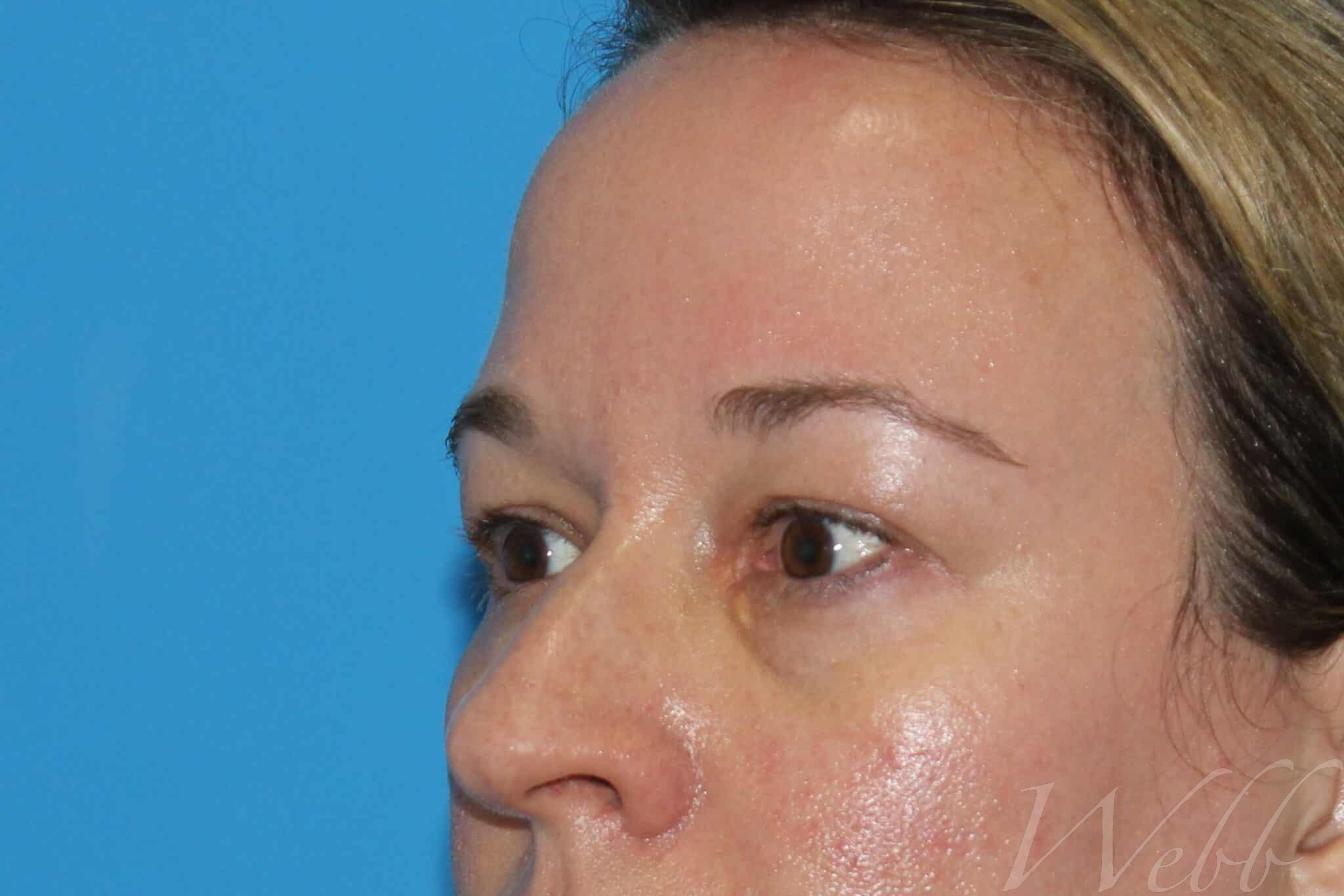 eyelid rejuvenation patient
