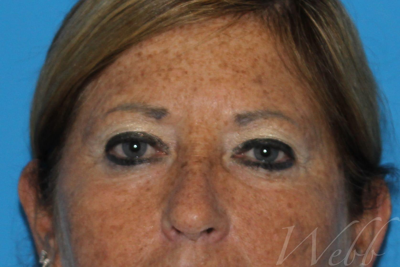 eyelid rejuvenation patient