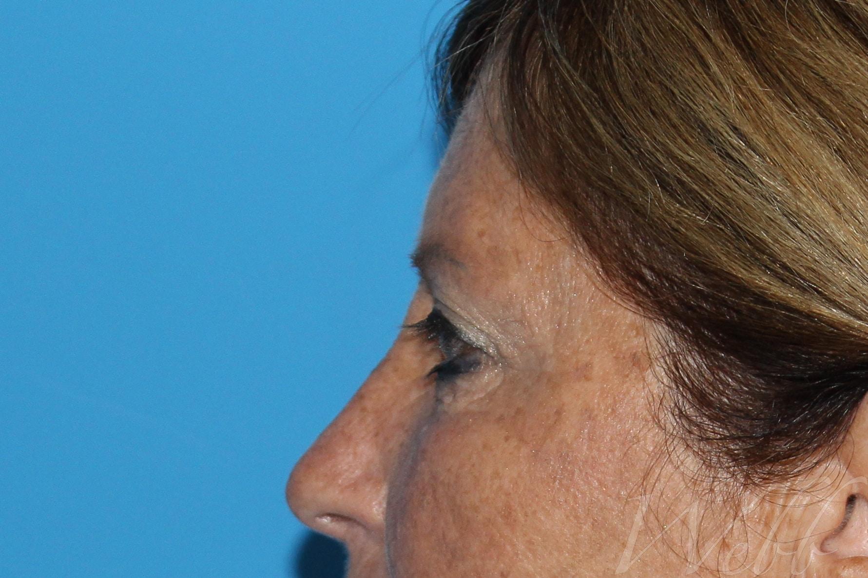 eyelid rejuvenation patient