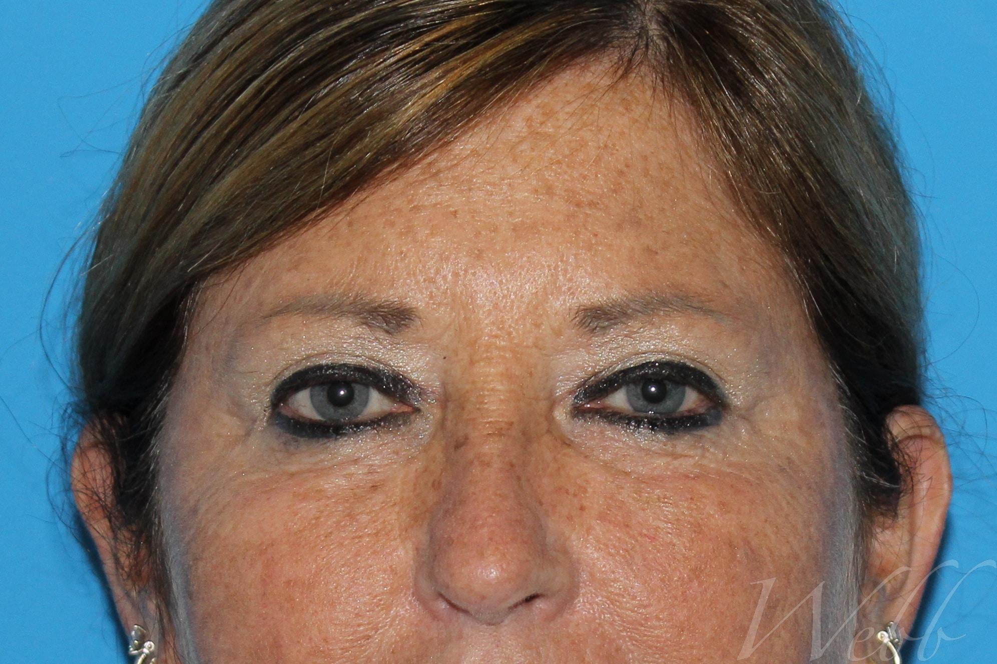 eyelid rejuvenation patient