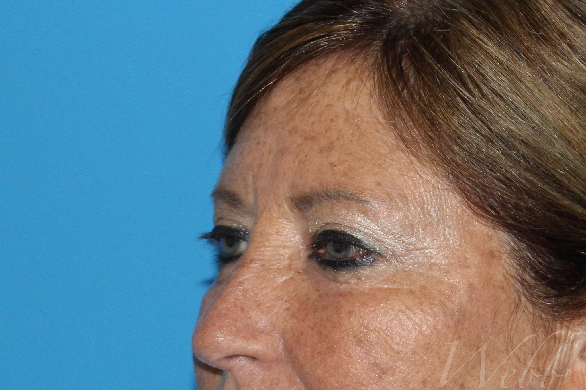 eyelid rejuvenation patient