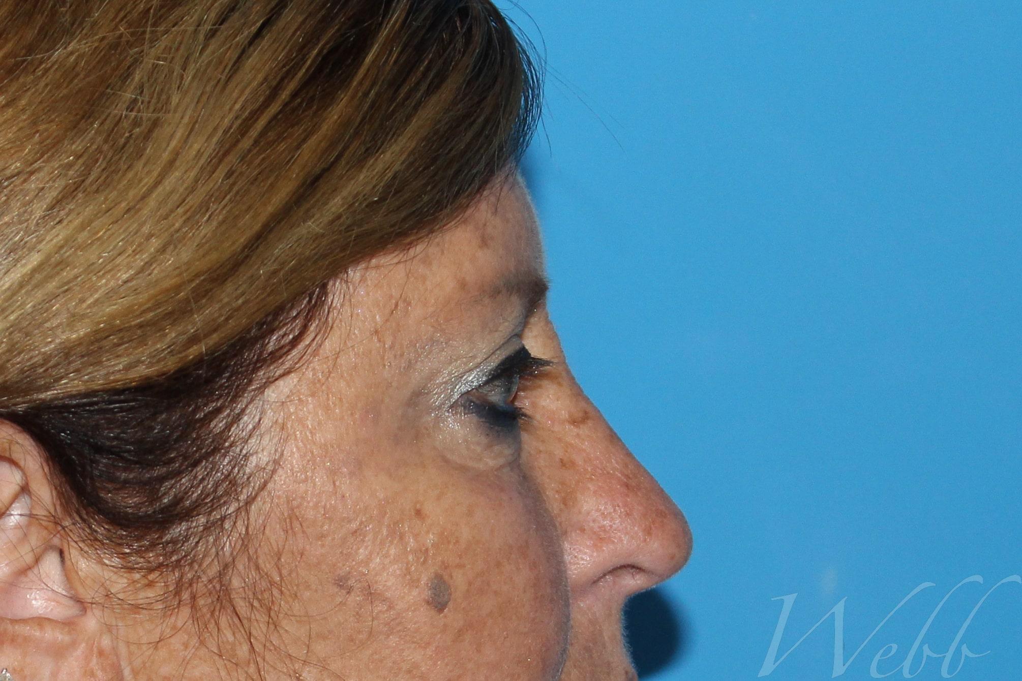 eyelid rejuvenation patient