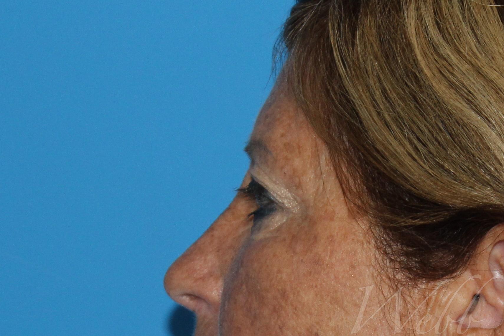 eyelid rejuvenation patient