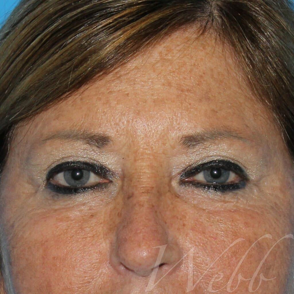 eyelid rejuvenation patient