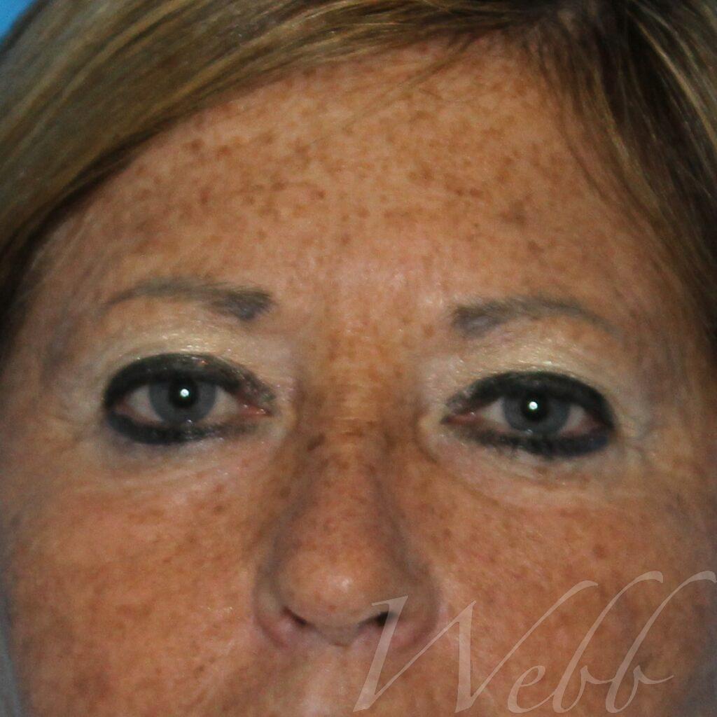 eyelid rejuvenation patient