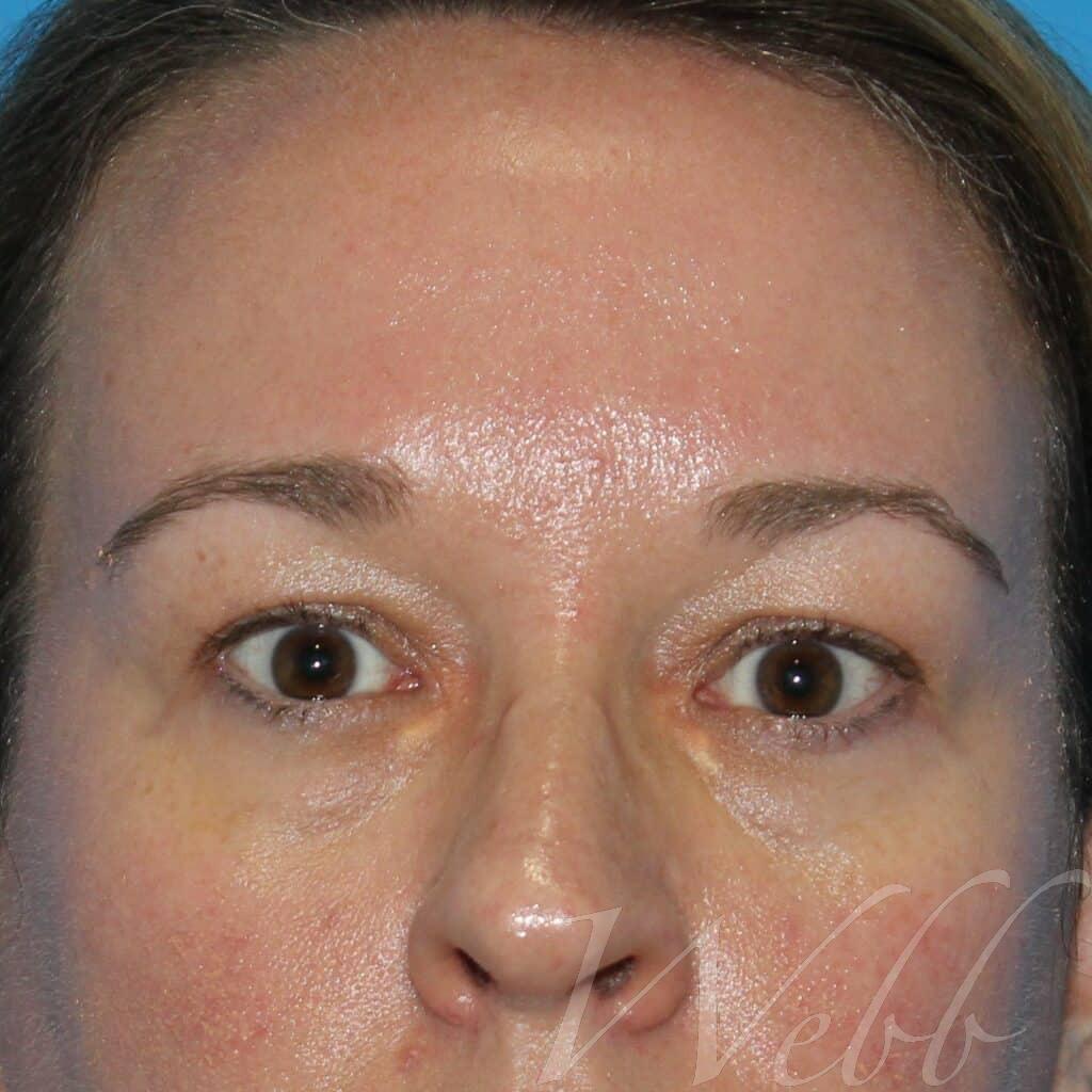 eyelid rejuvenation patient