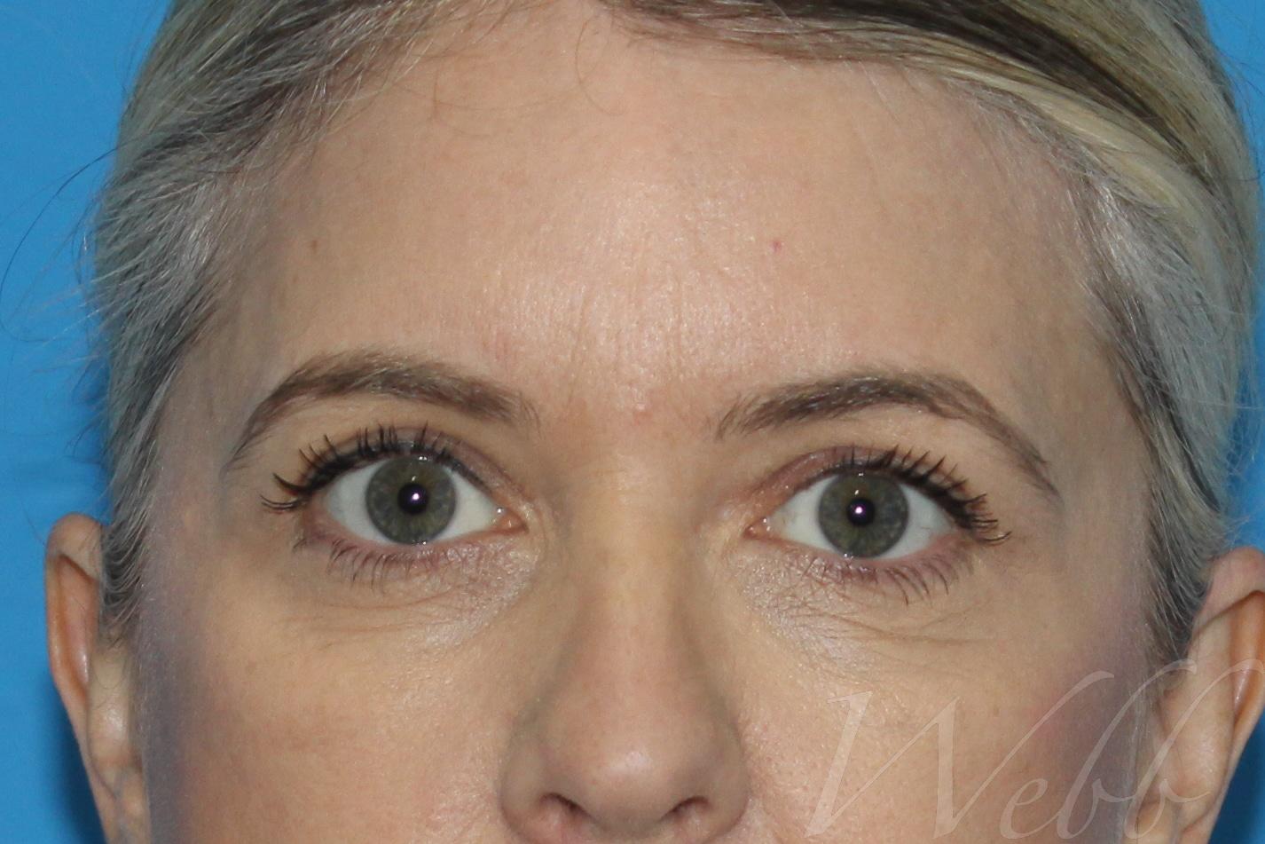 eyelid rejuvenation patient
