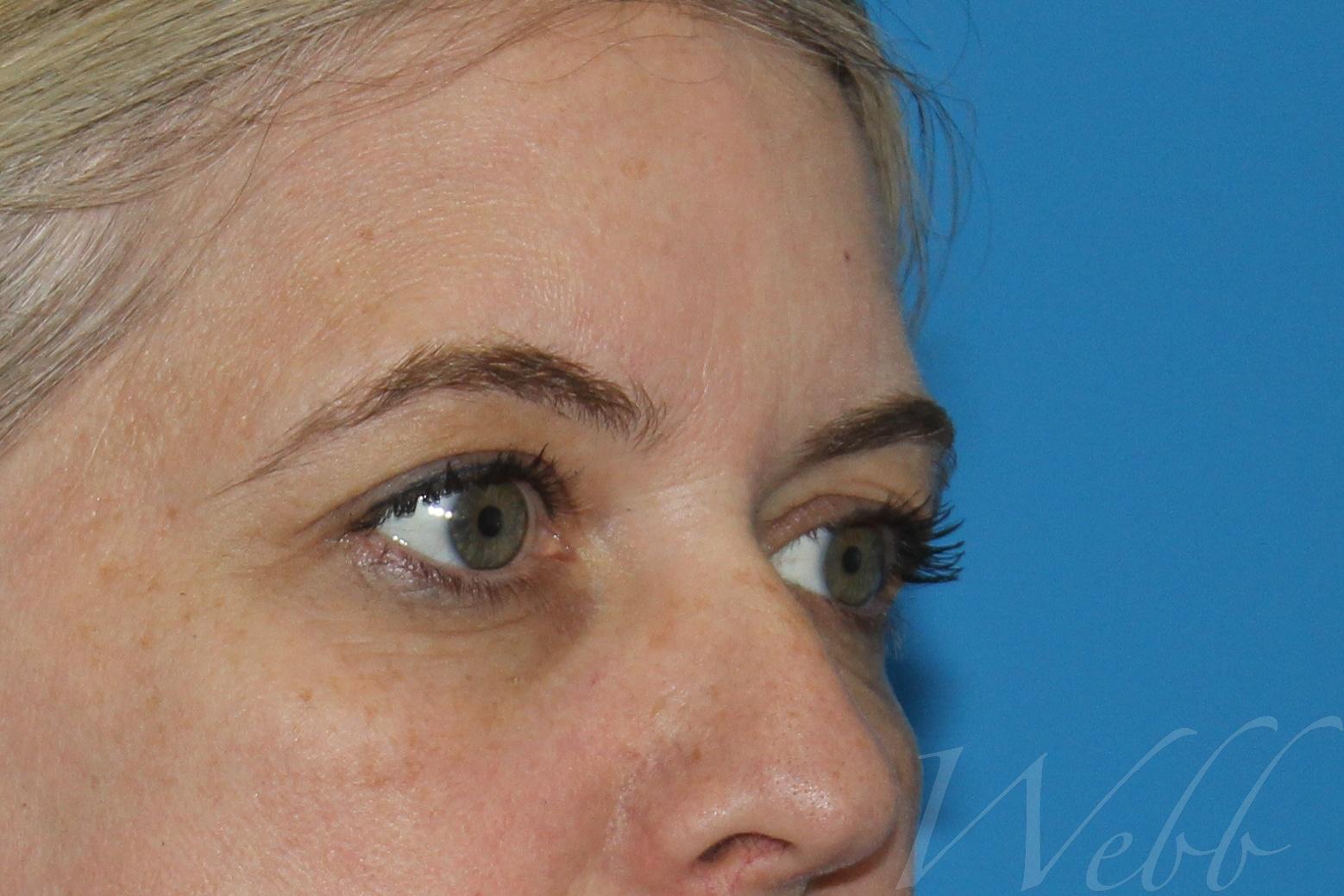 eyelid rejuvenation patient