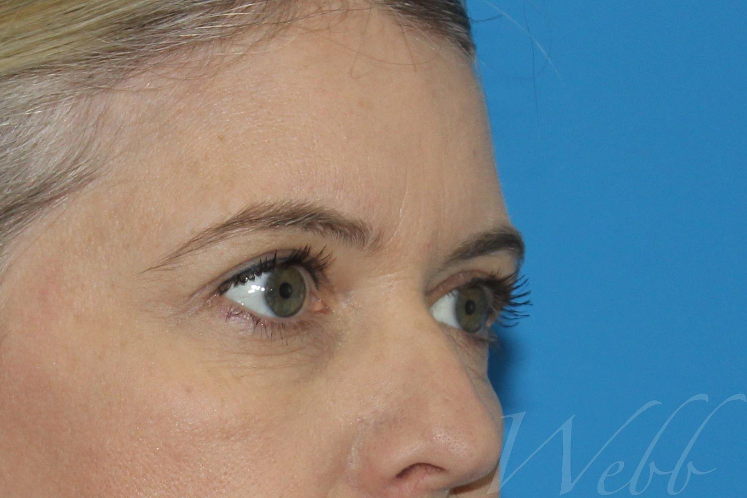 eyelid rejuvenation patient