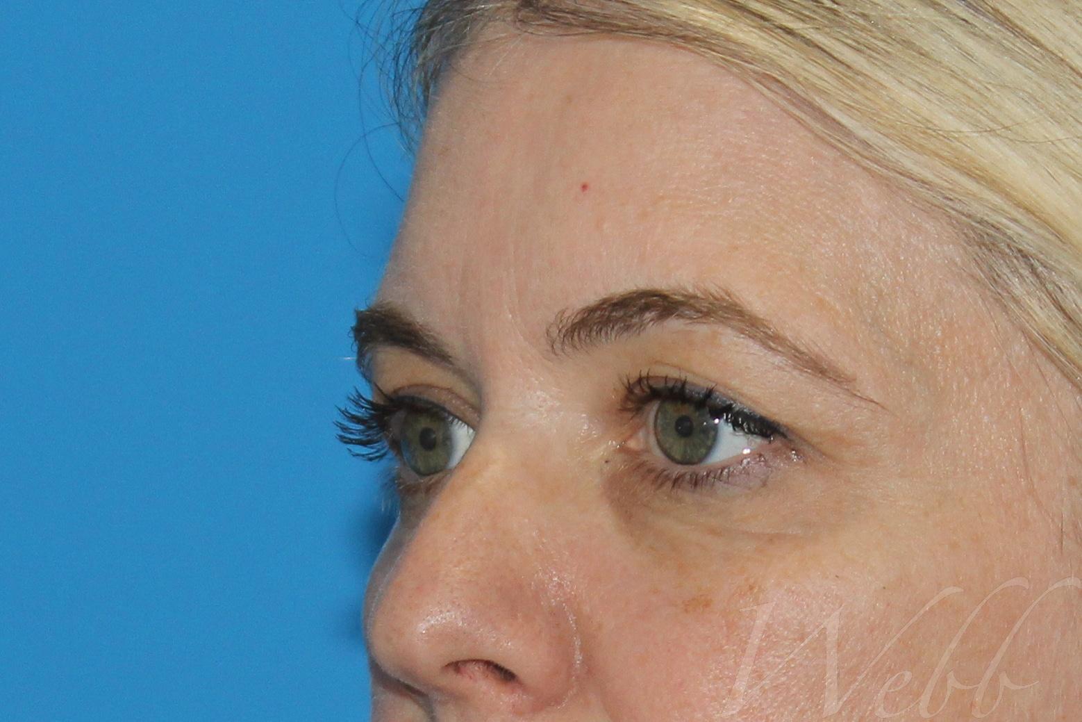 eyelid rejuvenation patient