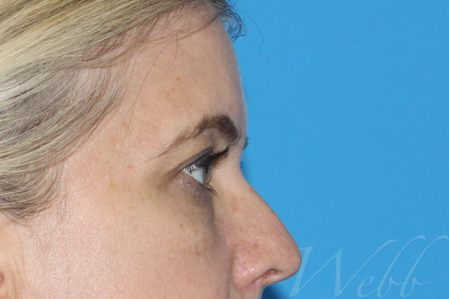 eyelid rejuvenation patient