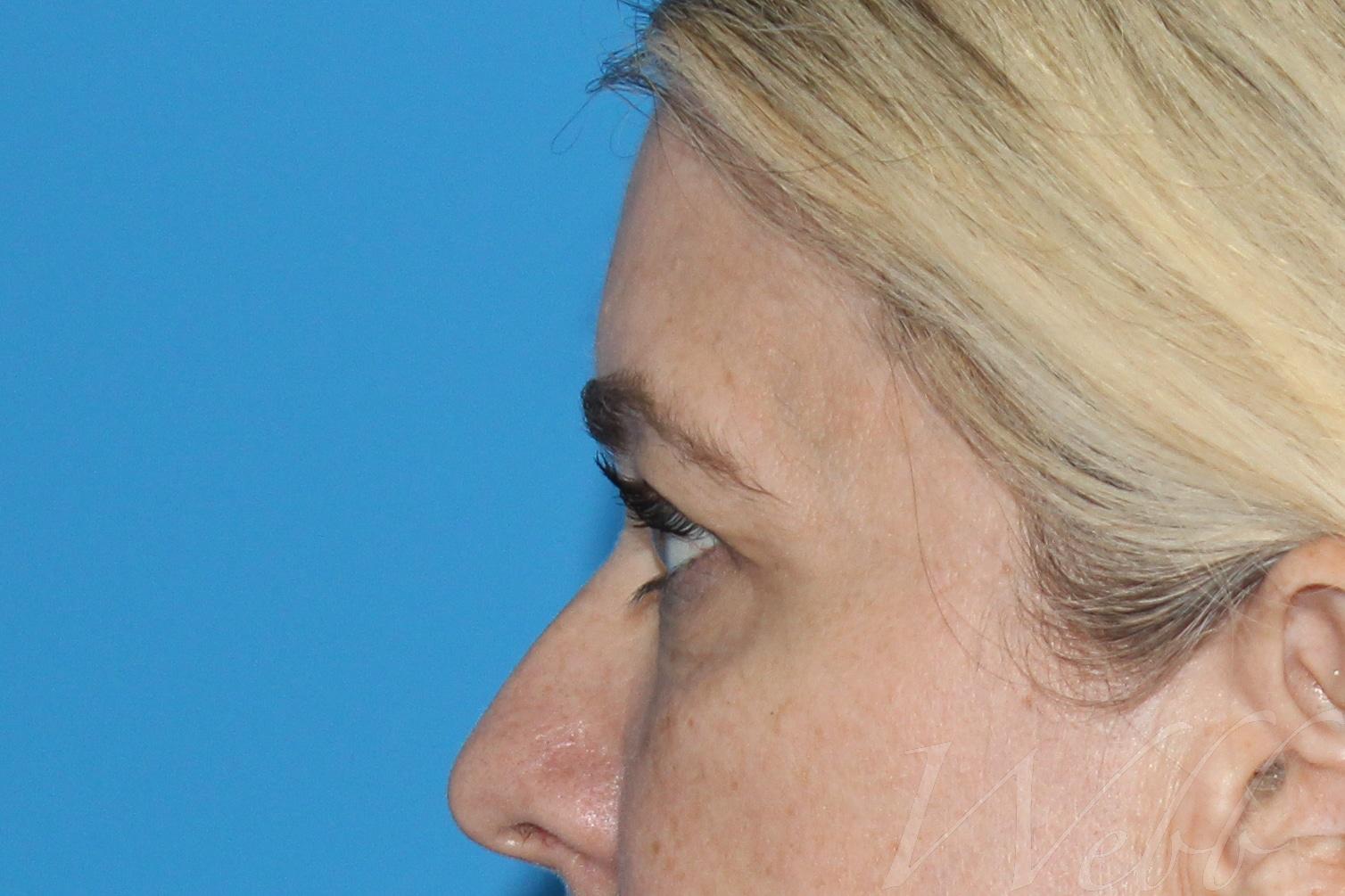 eyelid rejuvenation patient