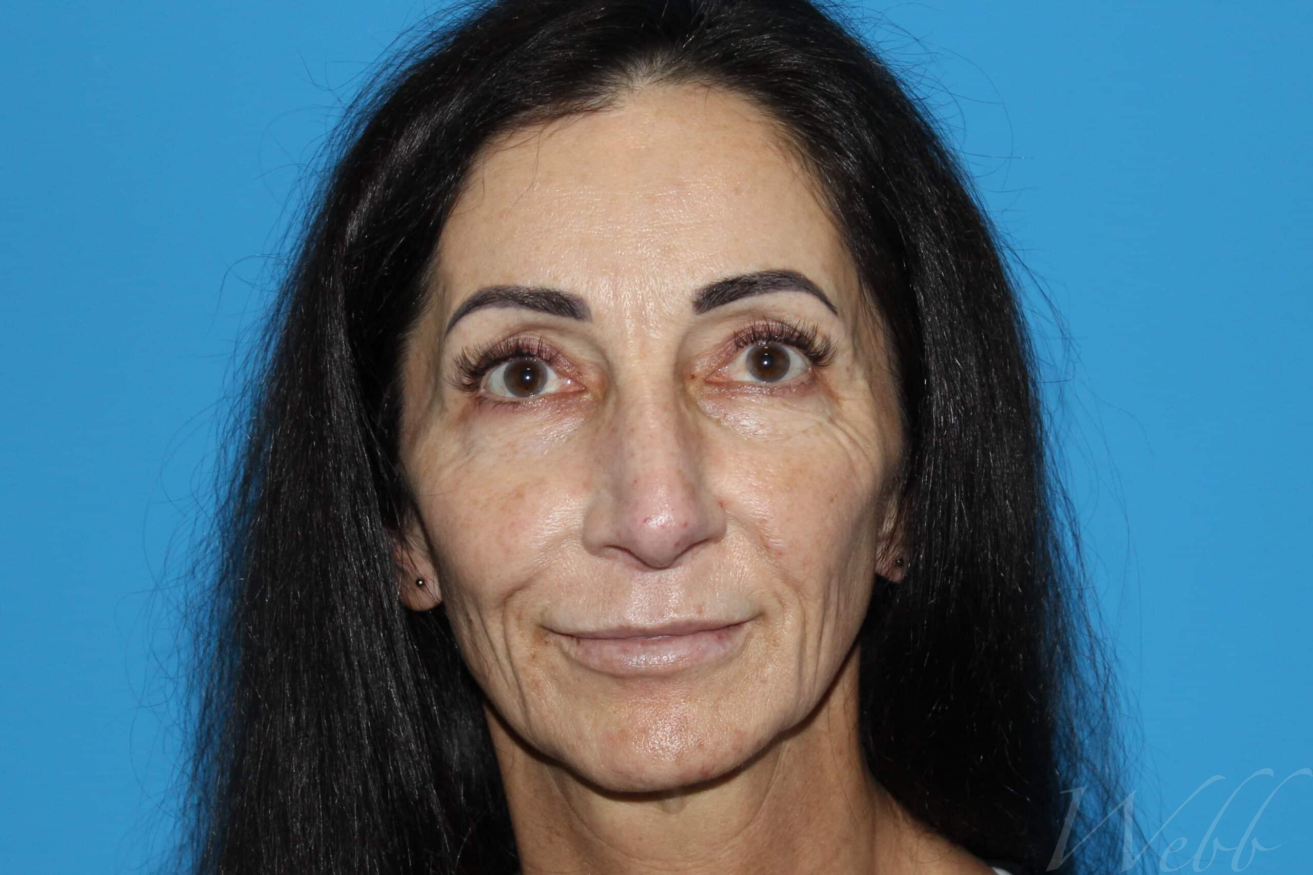 eyelid rejuvenation patient