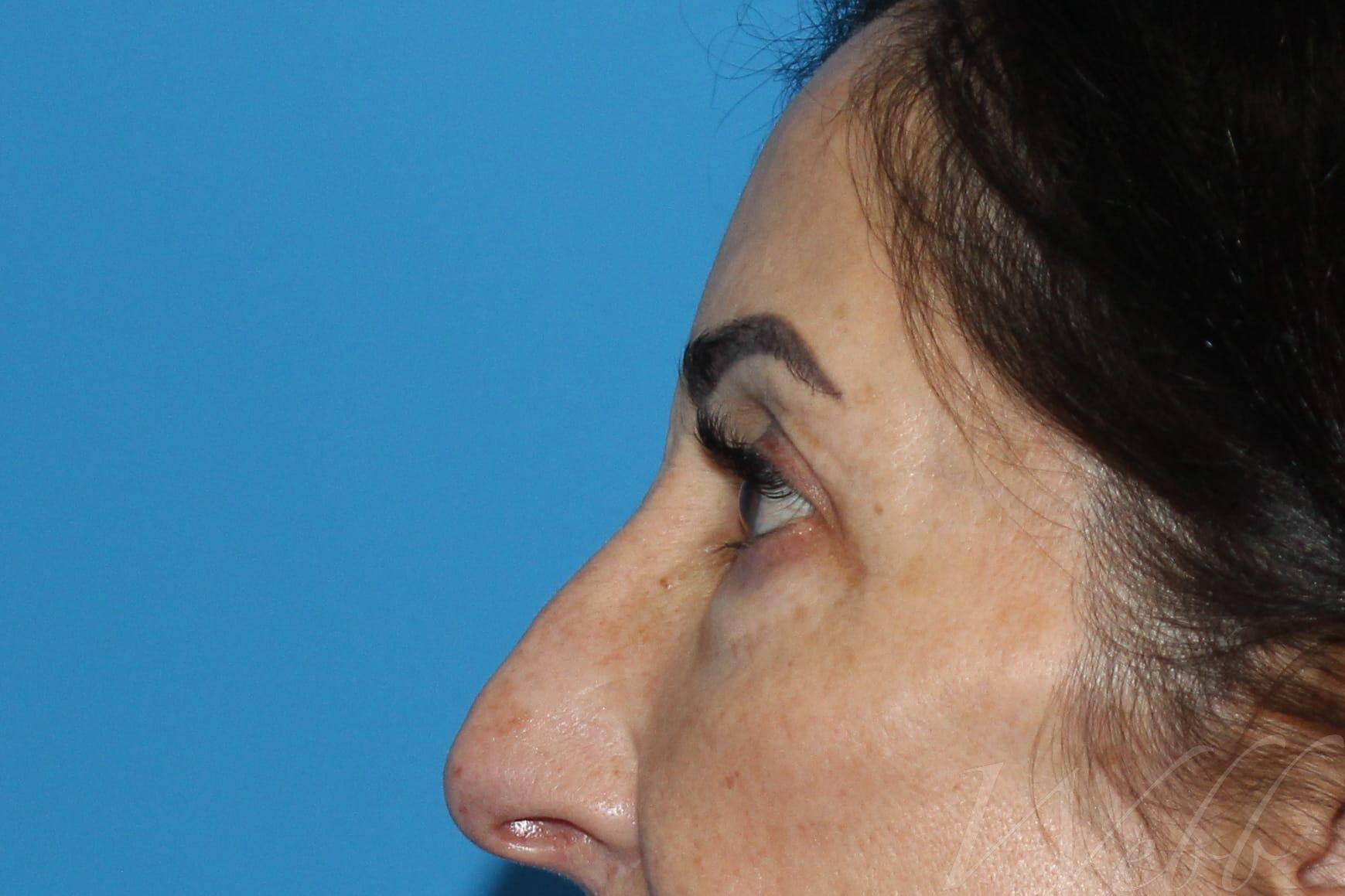 eyelid rejuvenation patient