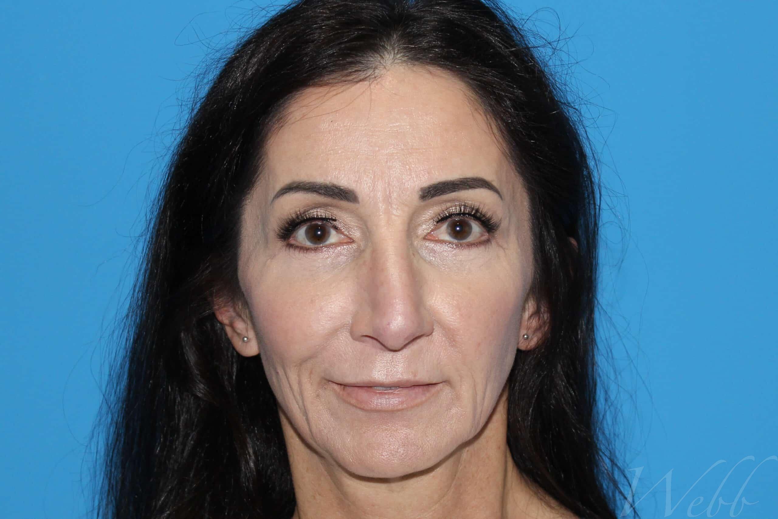 eyelid rejuvenation patient