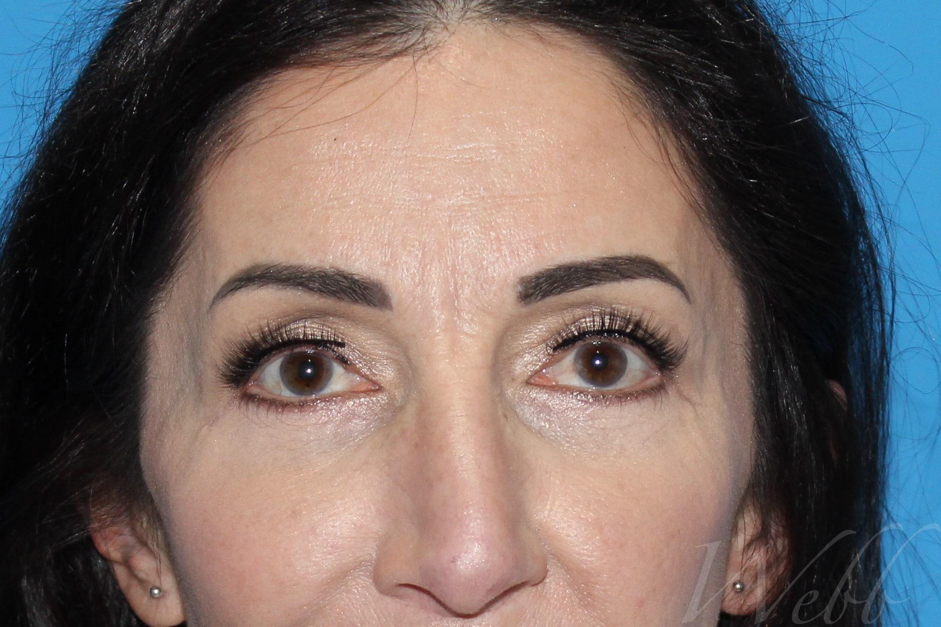 eyelid rejuvenation patient