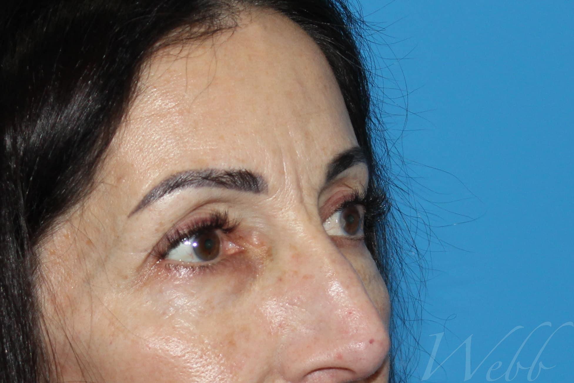 eyelid rejuvenation patient