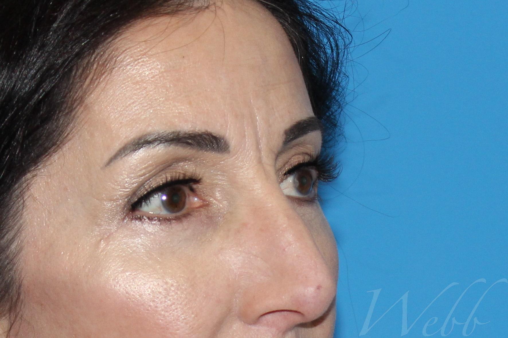 eyelid rejuvenation patient