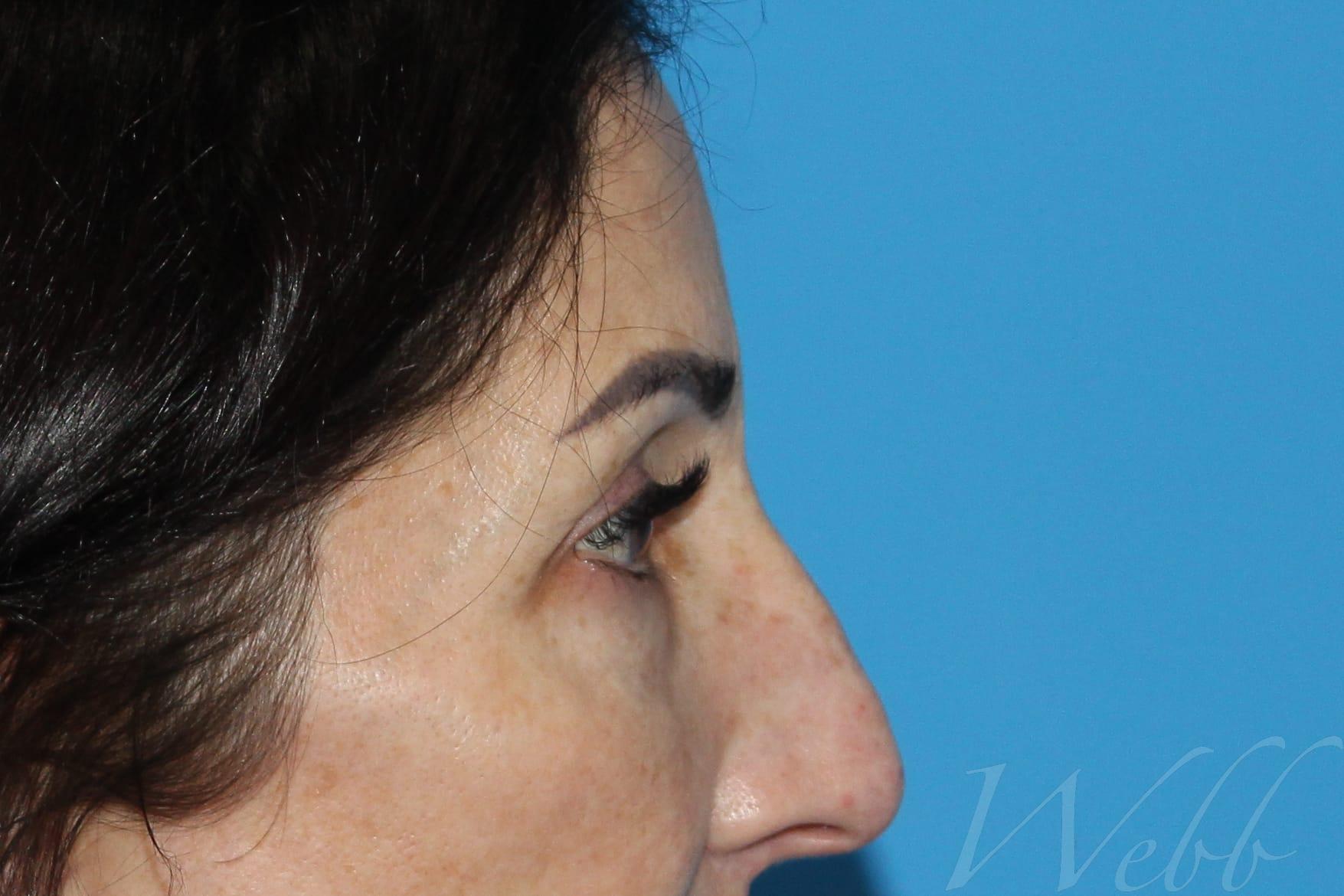 eyelid rejuvenation patient