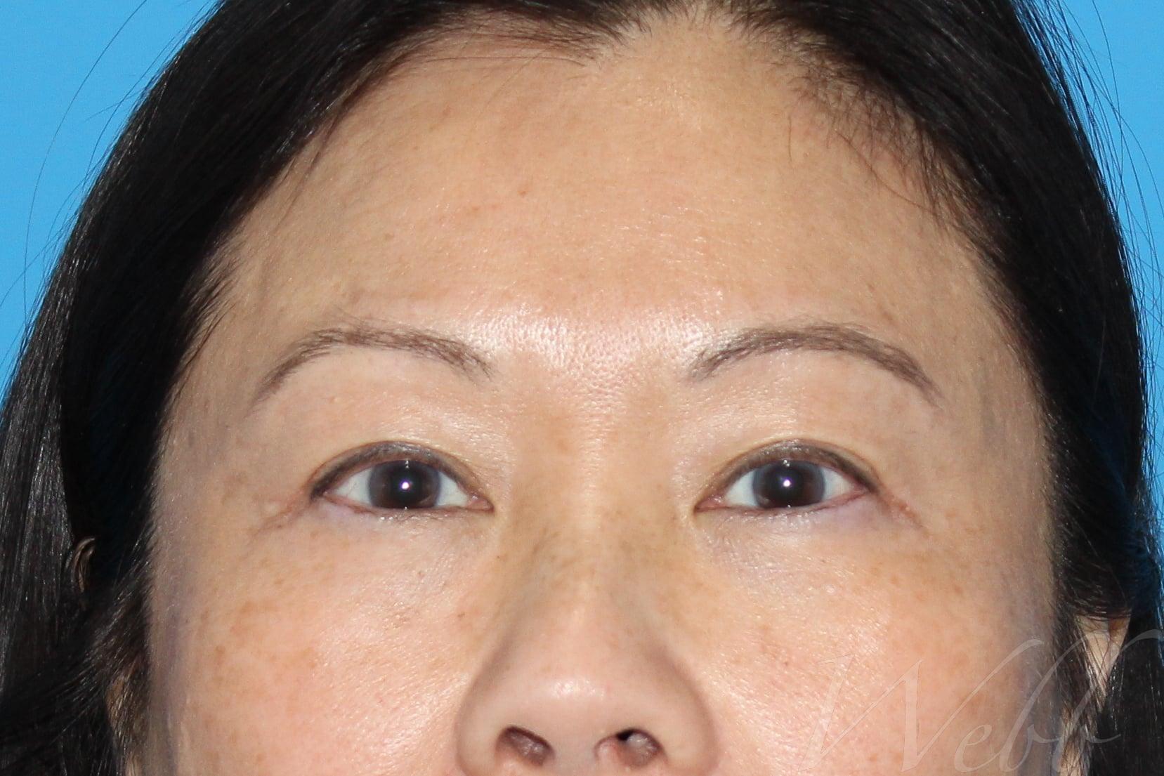 eyelid rejuvenation patient