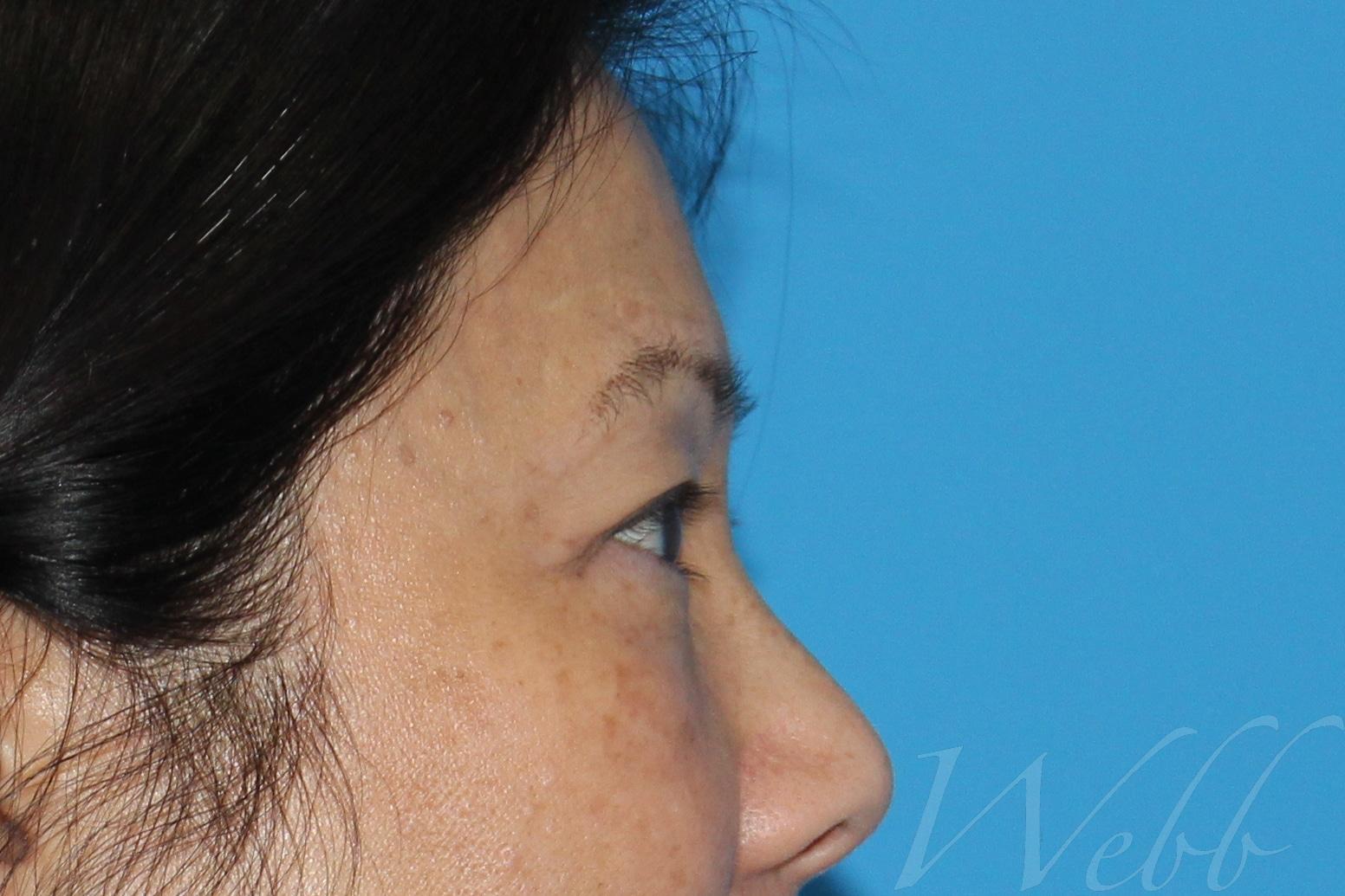 eyelid rejuvenation patient