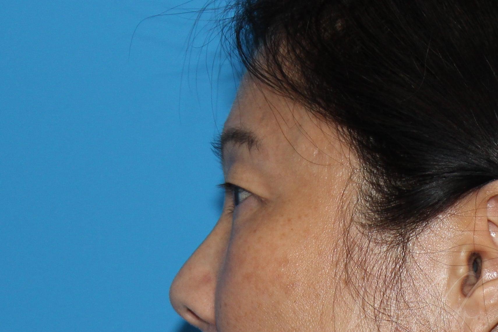 eyelid rejuvenation patient
