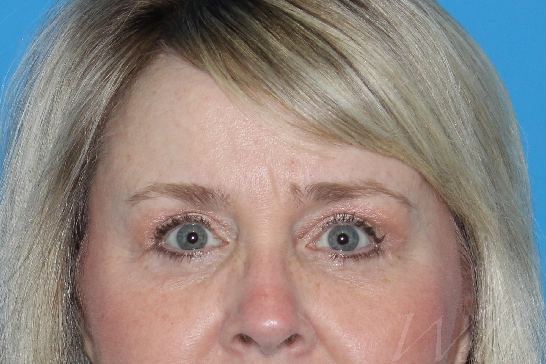 eyelid rejuvenation patient