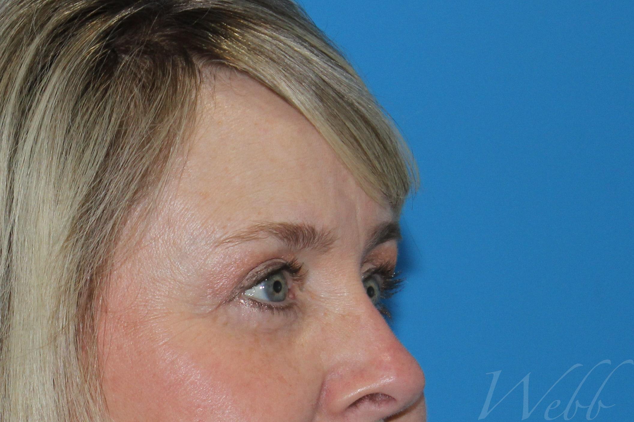 eyelid rejuvenation patient