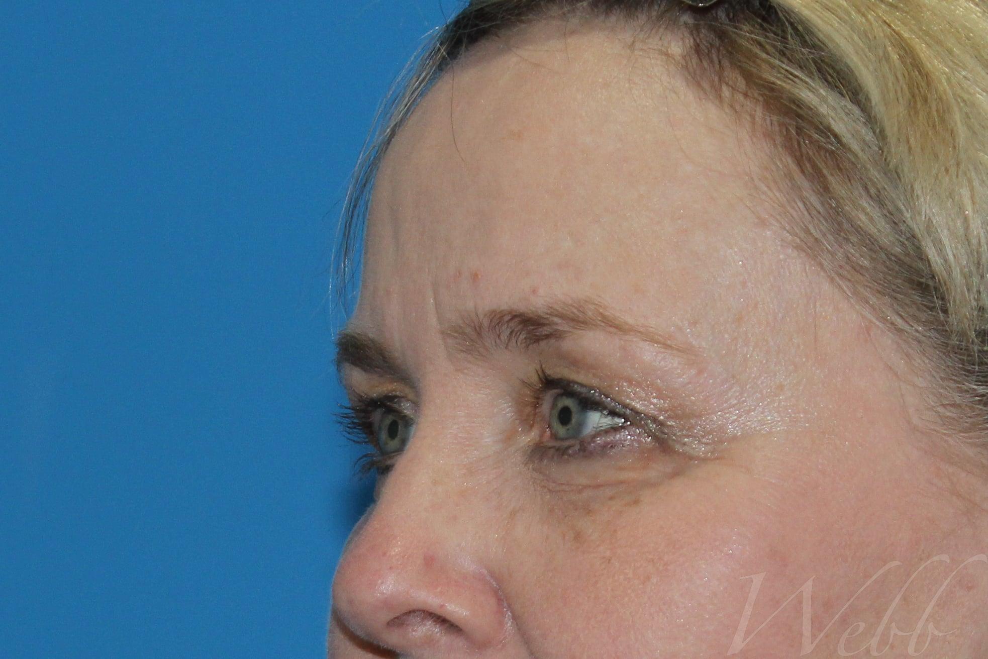 eyelid rejuvenation patient