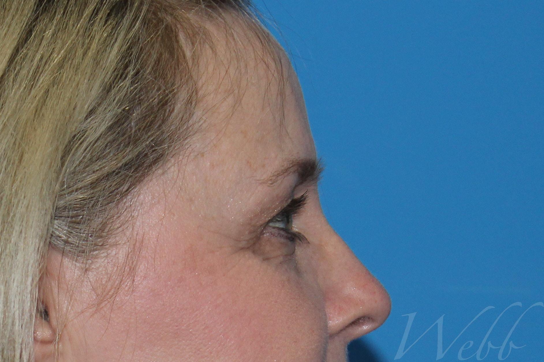 eyelid rejuvenation patient