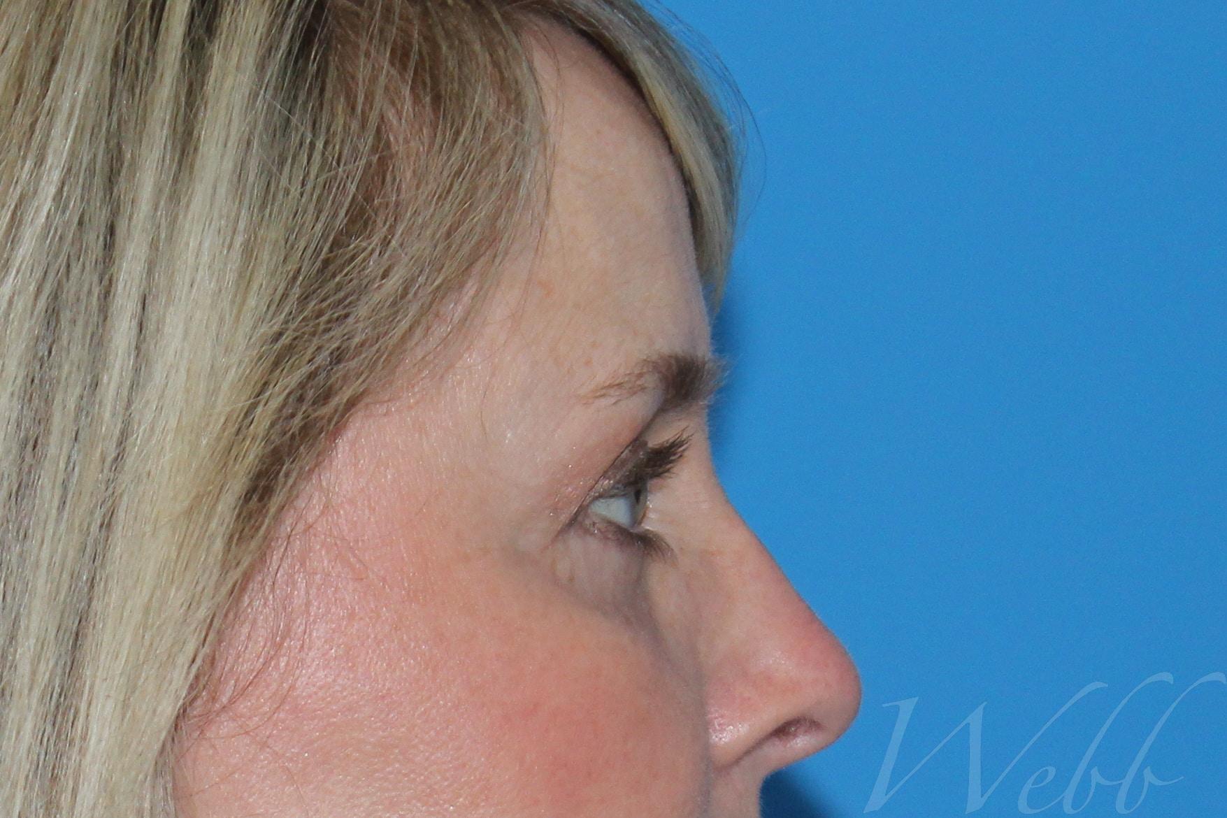 eyelid rejuvenation patient