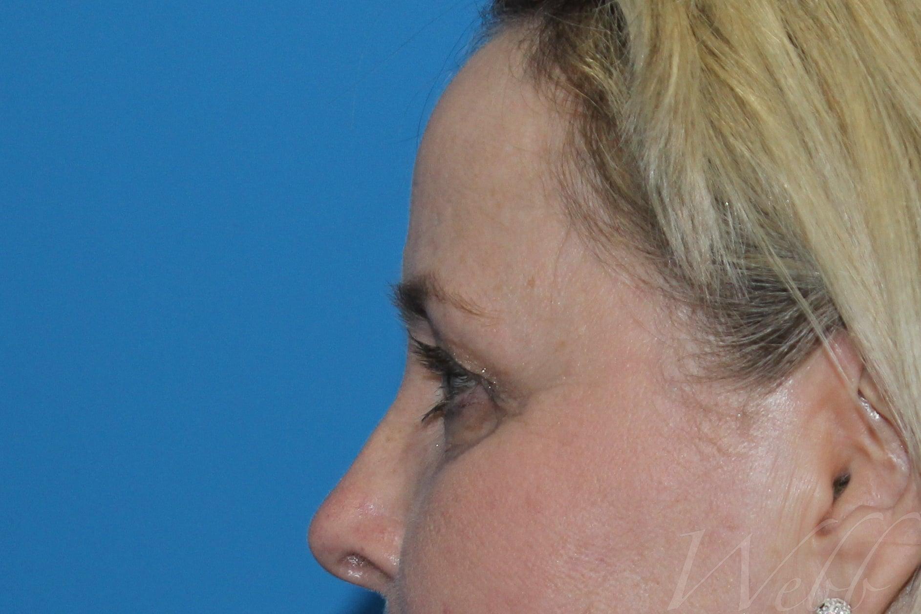 eyelid rejuvenation patient