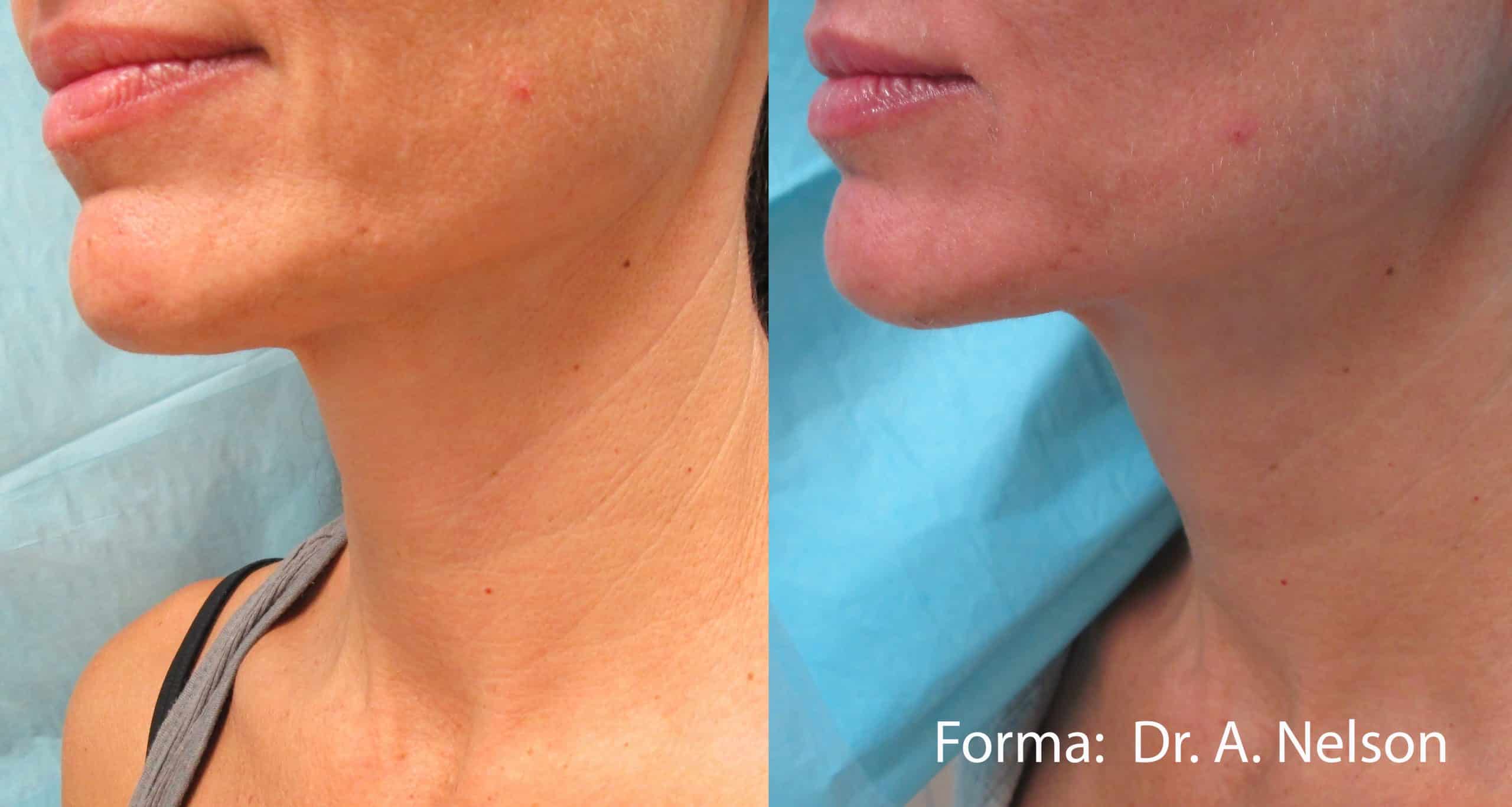 forma-before-after-dr-a-nelson-preview-3