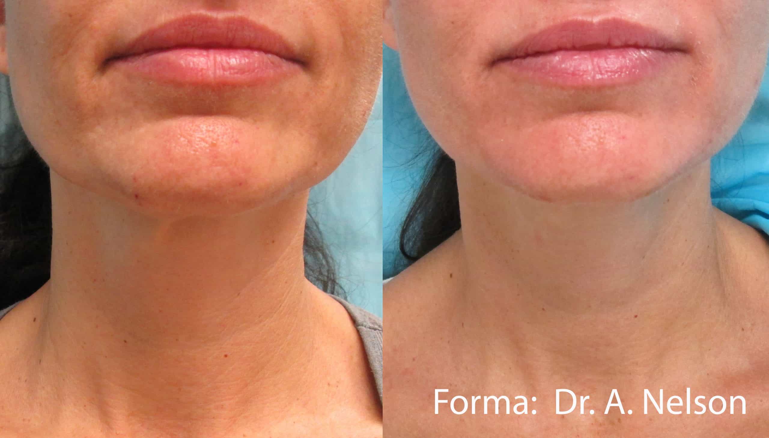 forma-before-after-dr-a-nelson-preview-4