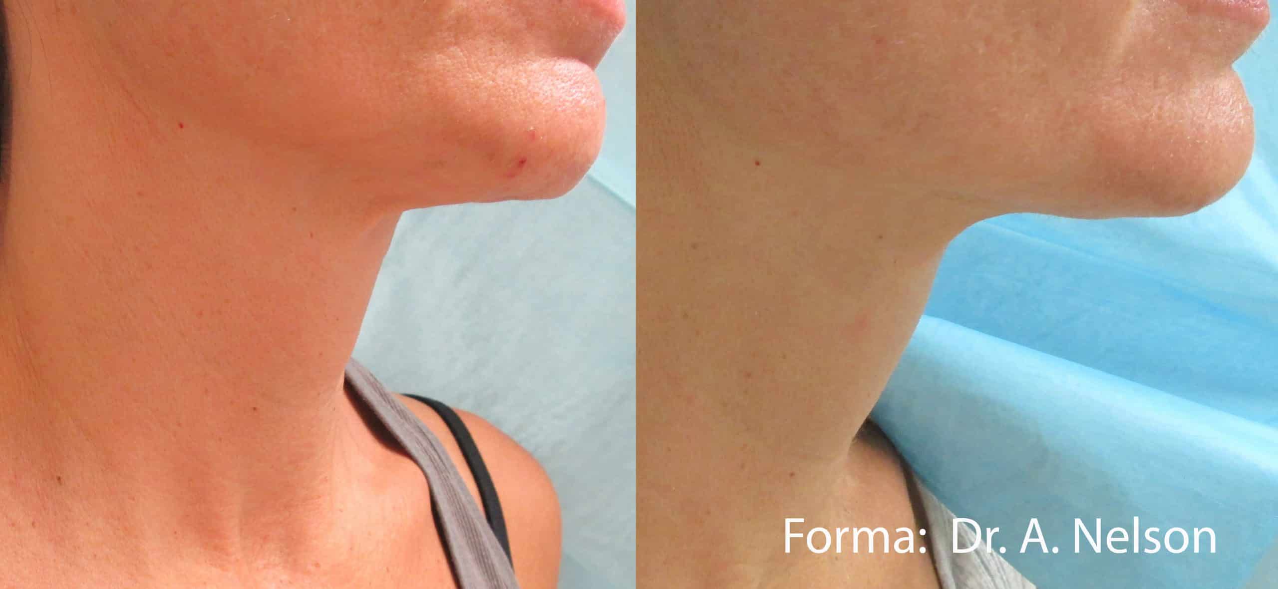 forma-before-after-dr-a-nelson-preview-5