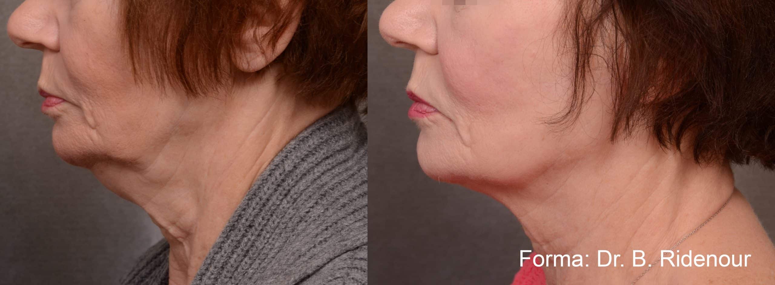 forma-before-after-dr-b-ridenour-preview-1