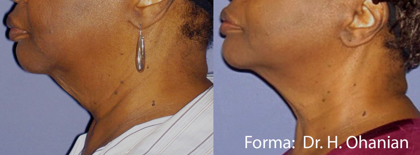 forma-before-after-dr-h-ohanian-preview-2