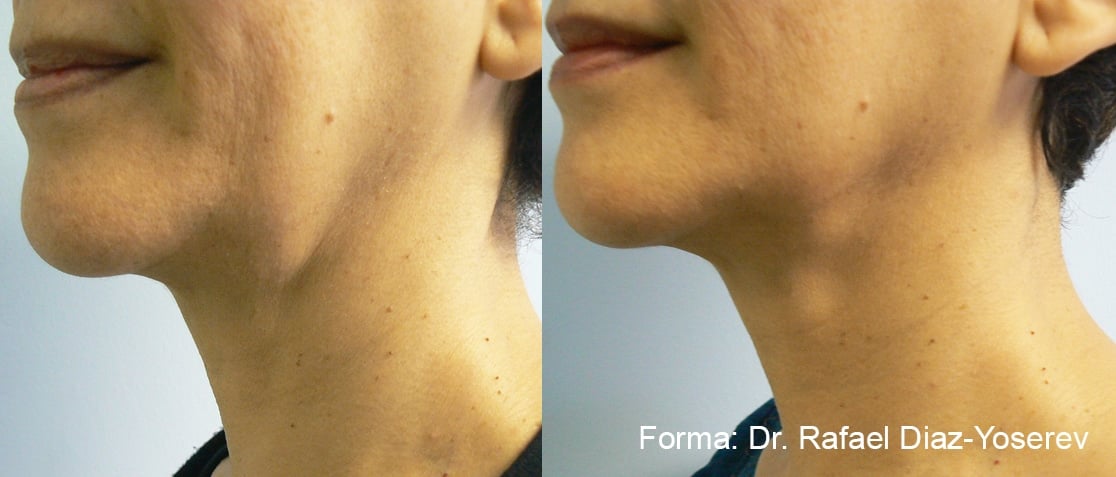 What Is Forma Skin Tightening? Its Benefits And How It Works