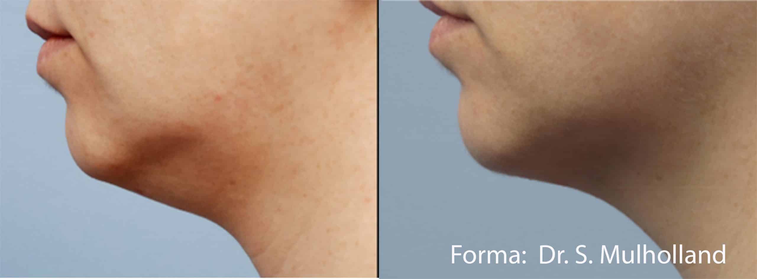 forma-before-after-dr-s-mulholland-preview-3